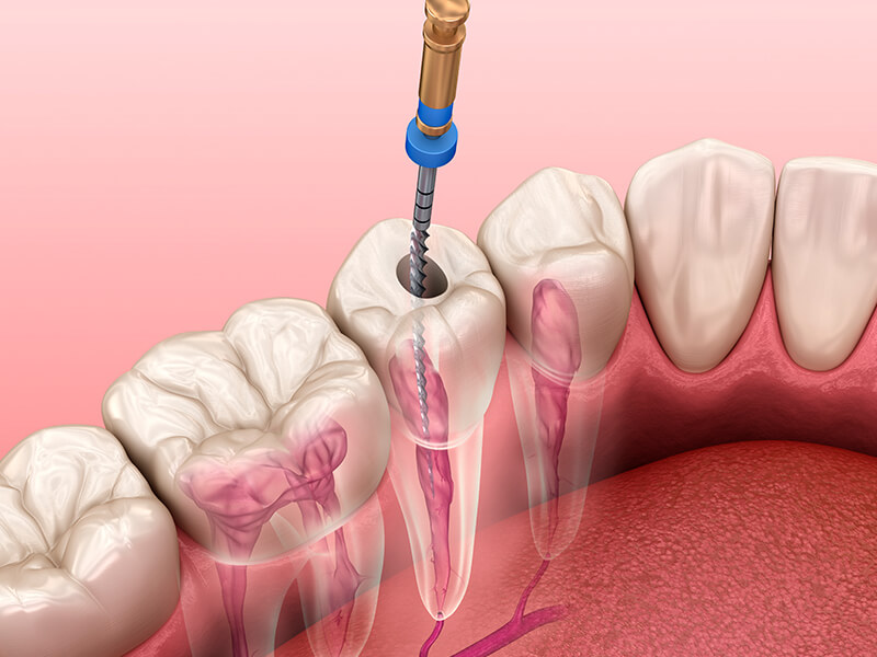 endodontia