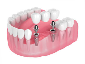 implantes dentários