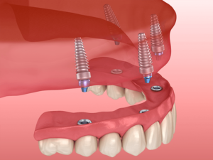 próteses dentárias